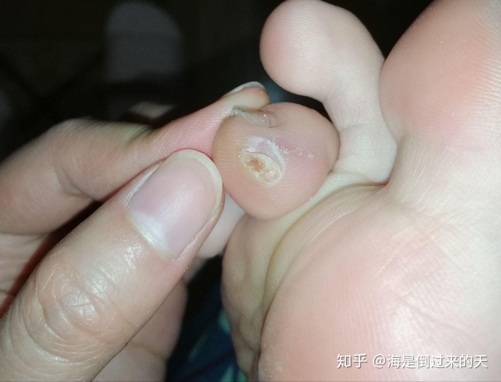 治疗瘊子疣的无痛过程