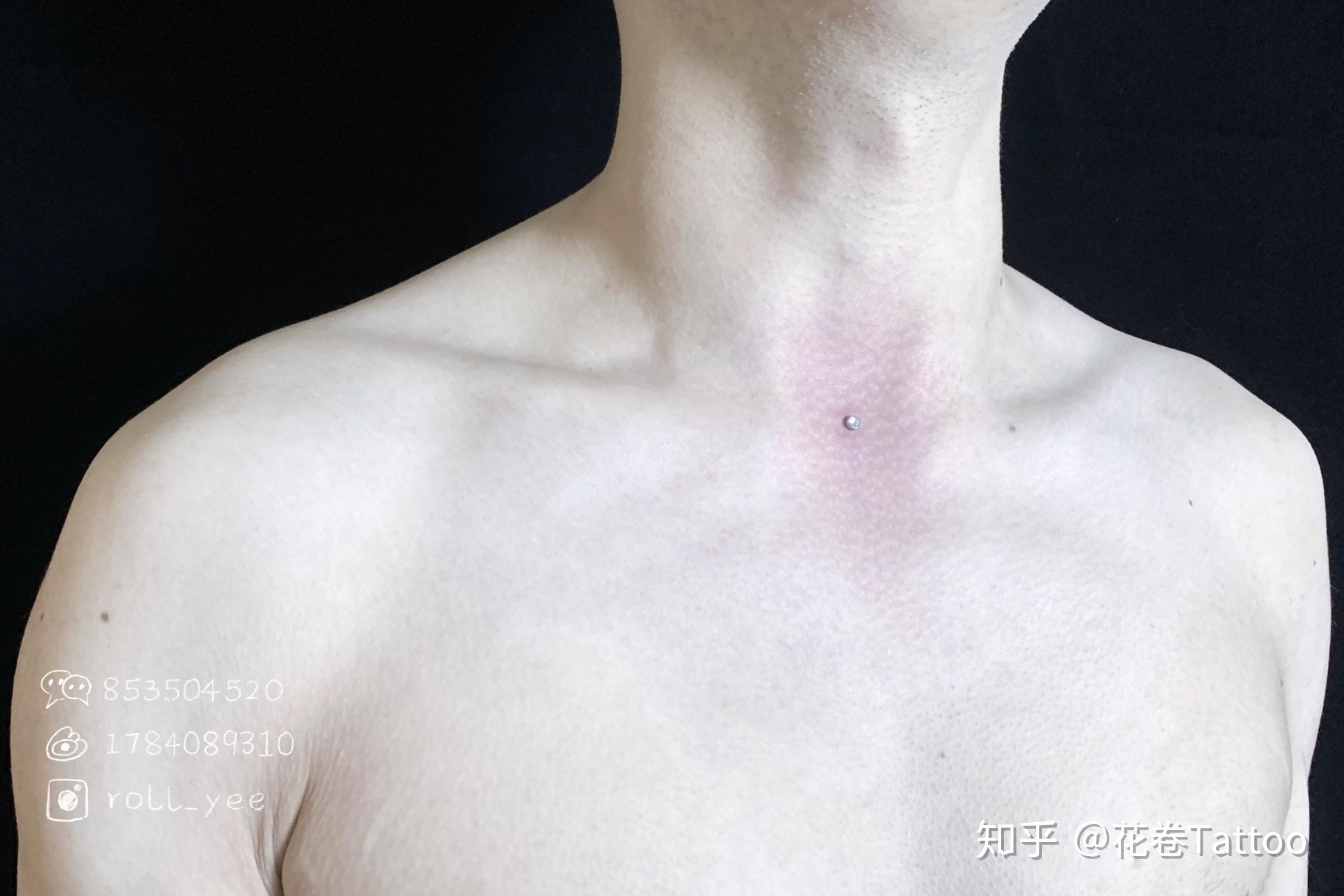 人体穿刺 || 穿孔的恢复时间周期