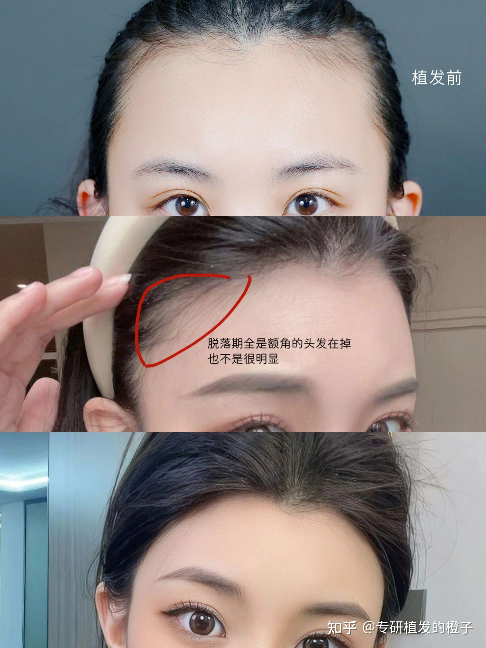 无锡有名的植发医生是(无锡有名的植发医生是哪家)