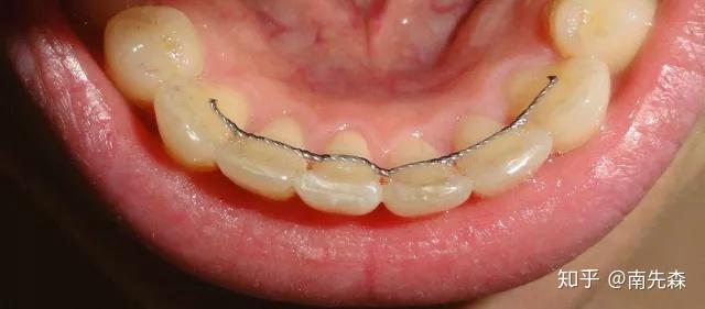 牙齿矫正后居然还会复发?