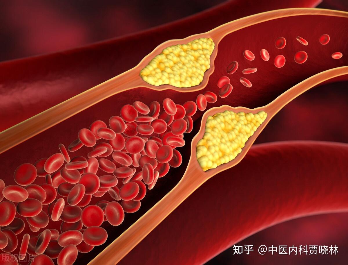 血管淤堵怎么办?两味药加一宝,活血化淤,血管畅通不粘稠 - 知乎