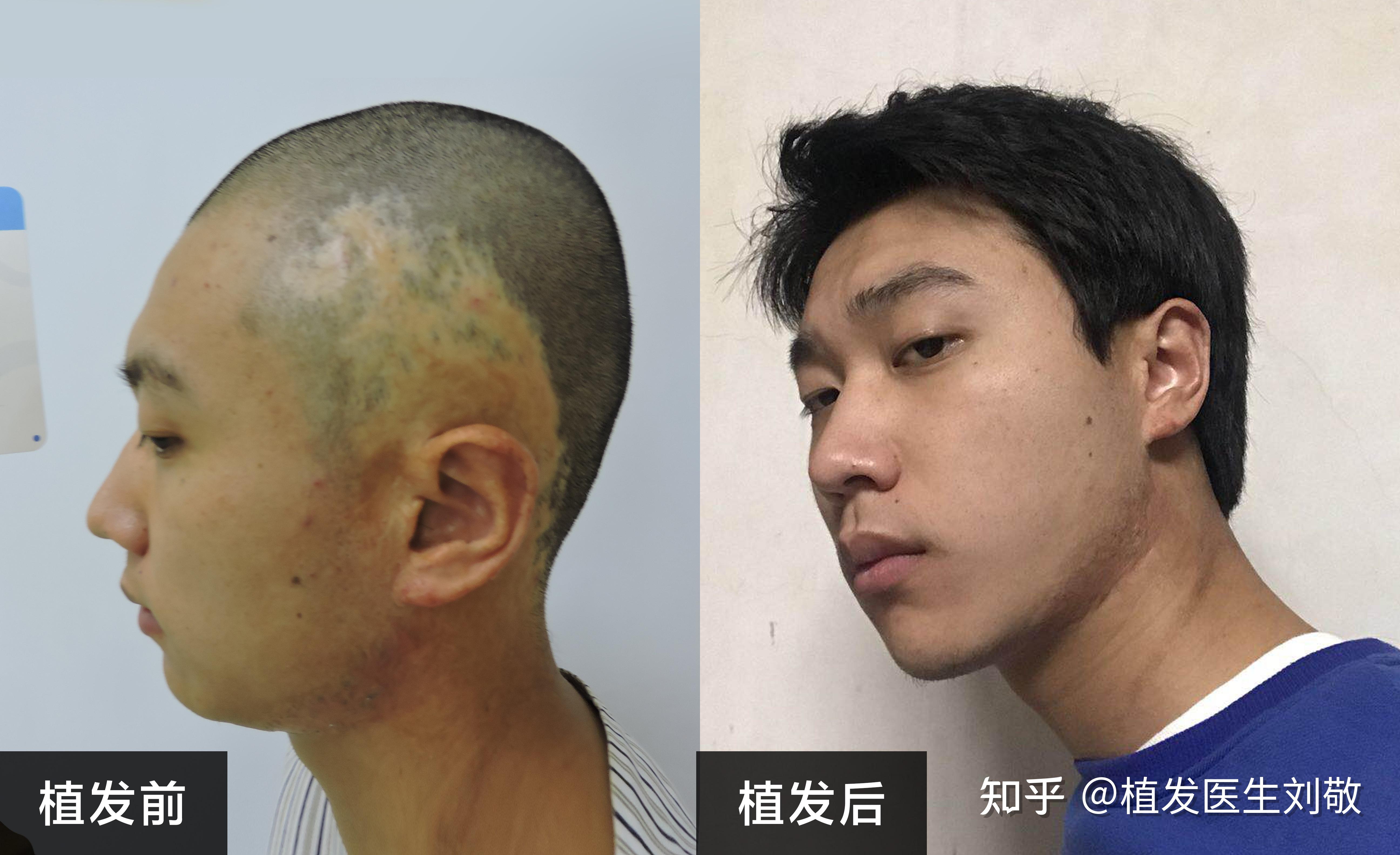 头上有疤痕,可以植发吗? - 知乎