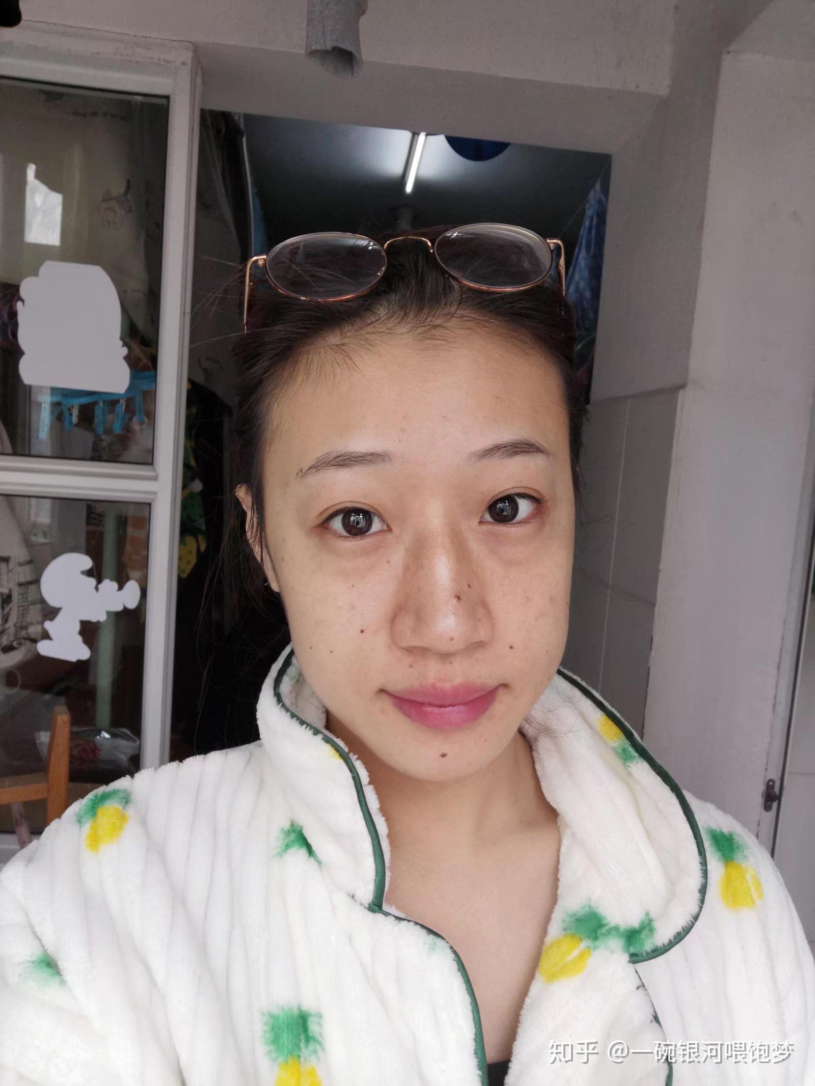 激光电烧祛痣点痣记录