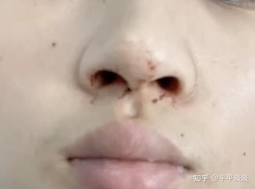 鼻窦炎手术详细过程鼻中隔弯曲双侧下鼻甲肥大