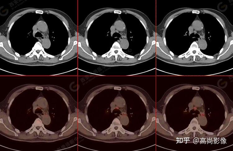 petct肺癌图片