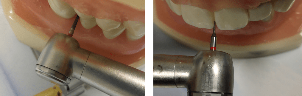 正畸医生须知邻面去釉工具与临床操作详解适应症禁忌症去釉量注意事项