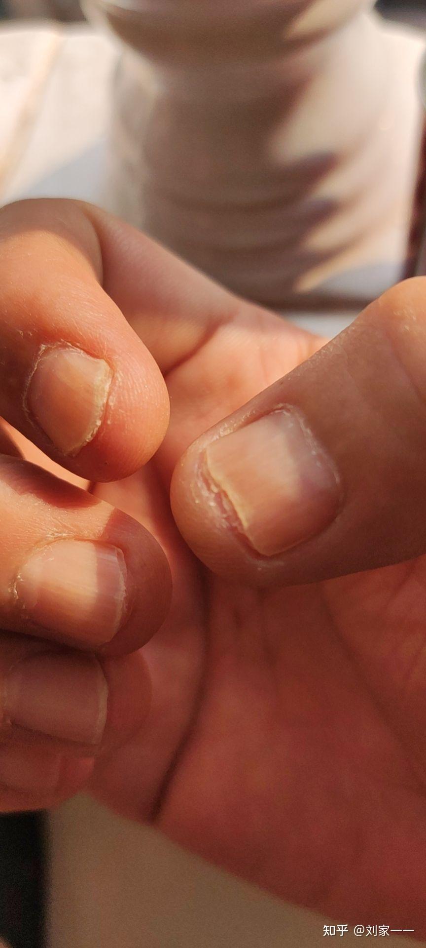 五个灰指甲治疗