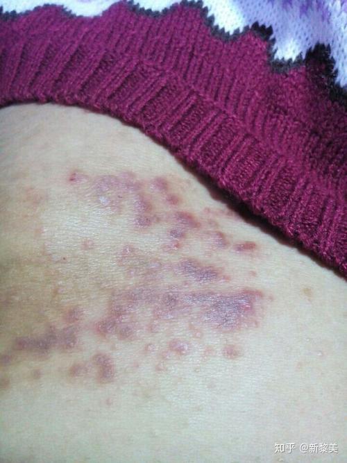 脱毛膏的副作用别再放任自己使用脱毛膏