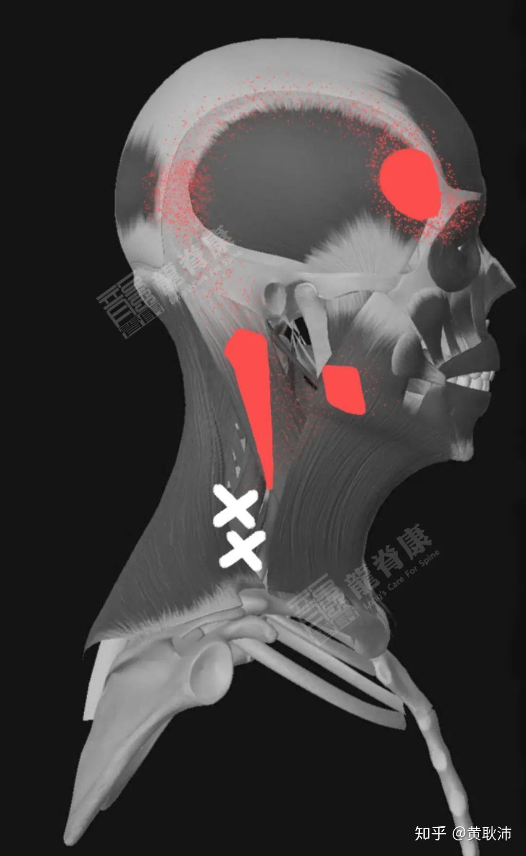 斜方肌1号触发点(图片来源:解剖大师)3,总结:单纯的手术抽脂只是把