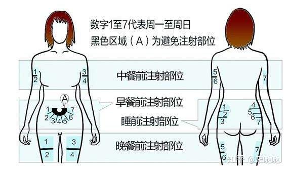 胰岛素部位图轮换图片