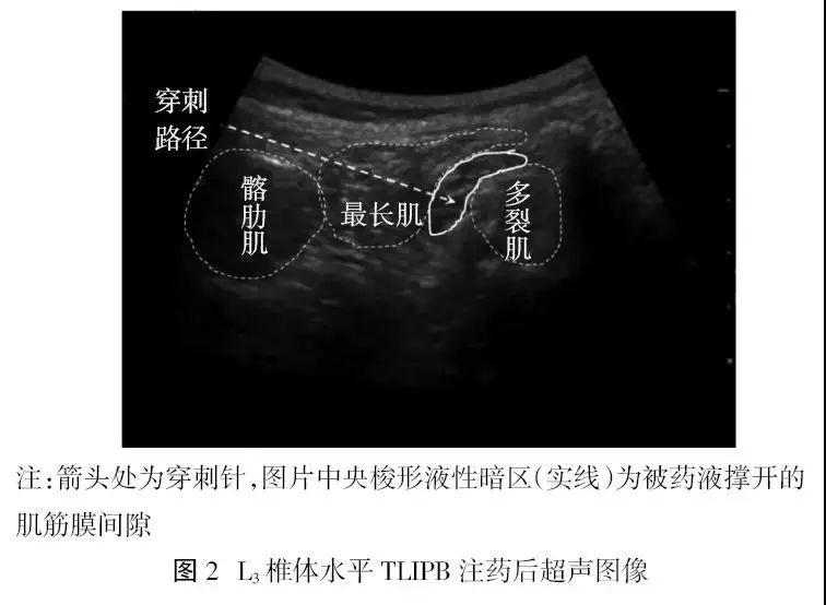 華聲臨床超聲可視化講座胸腰筋膜間平面阻滯對腰椎融合術後患者自控