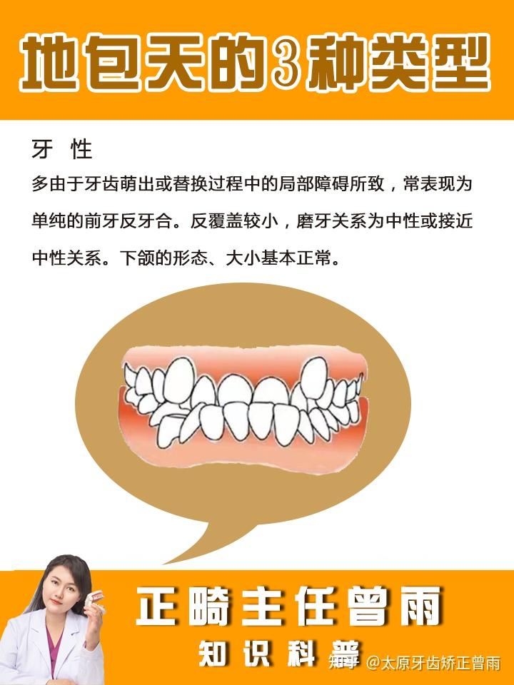 地包天可以矫正好吗?地包天的类型 - 知乎