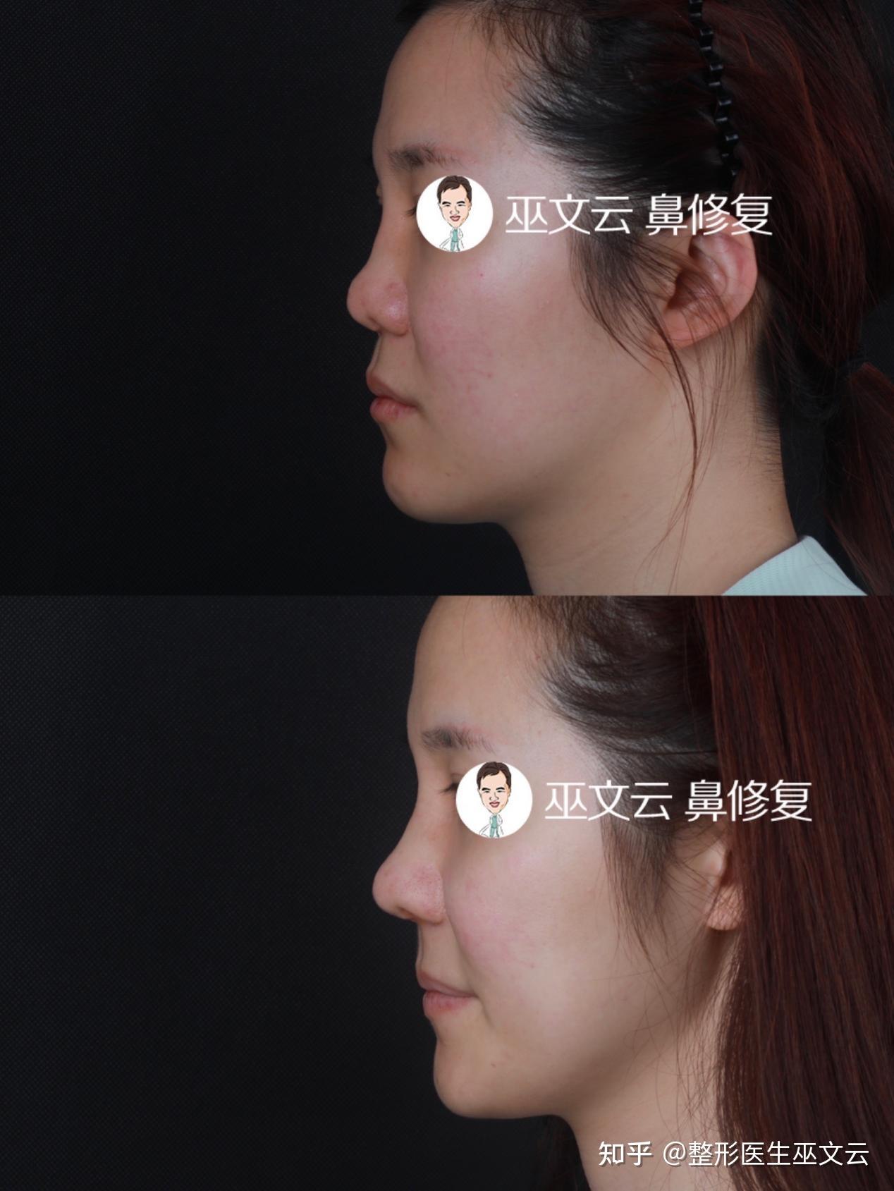 巫文云挛缩鼻修复集锦技术和审美都很重要