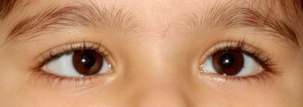 有关弱视的疑问以及解答