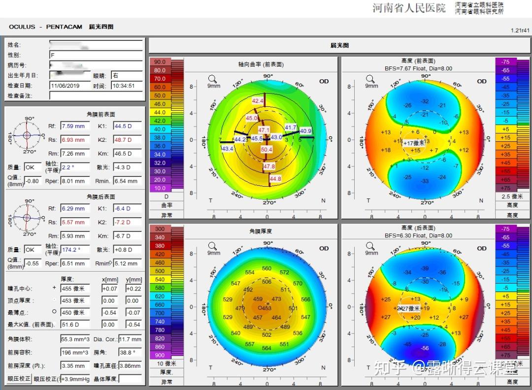 圆锥角膜的RGP验配及RGP临床效果分析（文字版） - 知乎