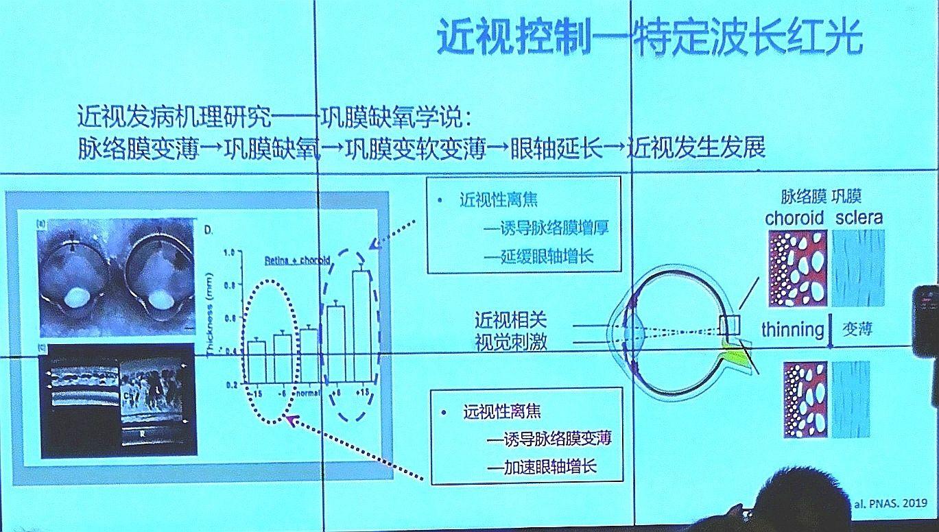 配戴角膜塑形镜后正焦环与近视控制的效果