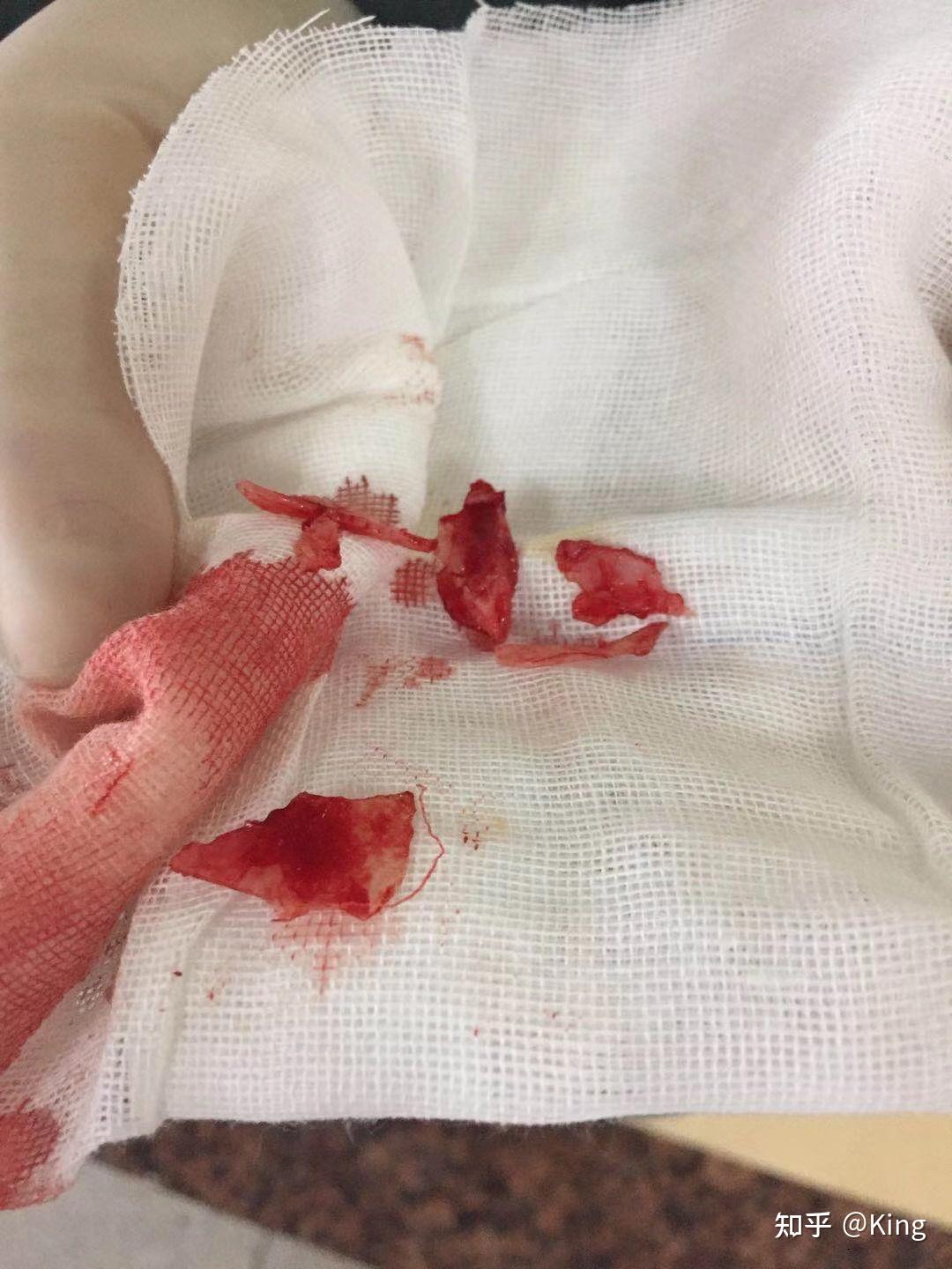 鼻甲肥大鼻炎到底要不要手术手术后复发