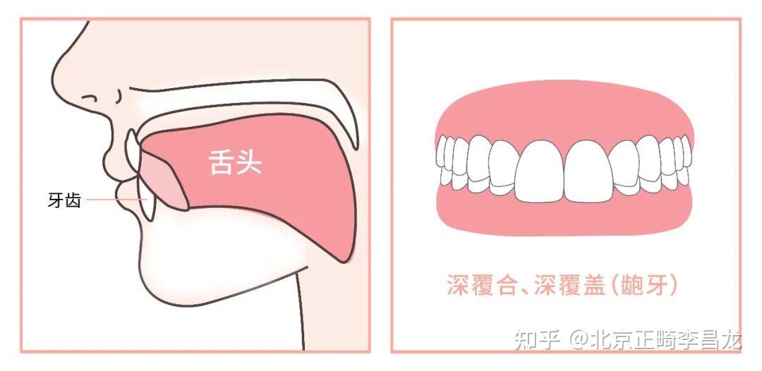 北京牙齿矫正丨舌头位置放错,影响那么大?快看看你的舌头放对位置了吗 - 知乎
