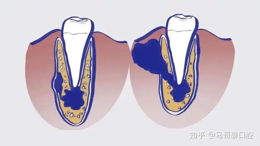 牙齿龋坏到什么程度,才需要做根管治疗 - 知乎