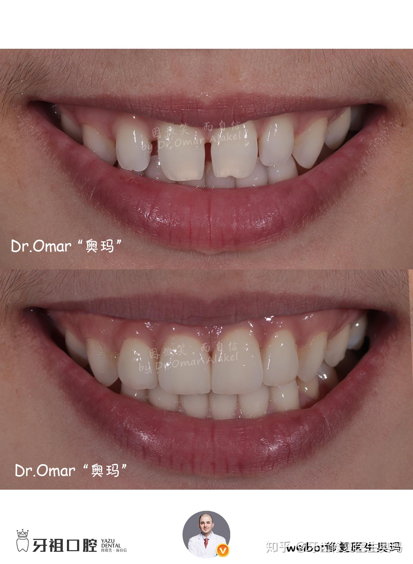 烤瓷牙骨性矫正|改善上牙龈突|调整嘴突面型|重建自信笑容 - 哔哩哔哩