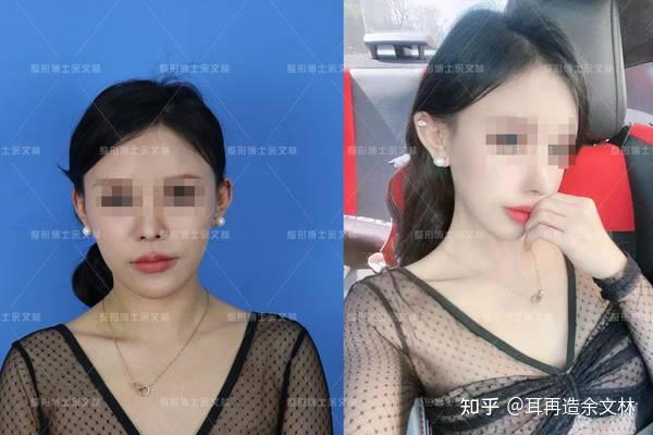 做了贴发耳矫正手术后 再也不用p耳朵了 知乎