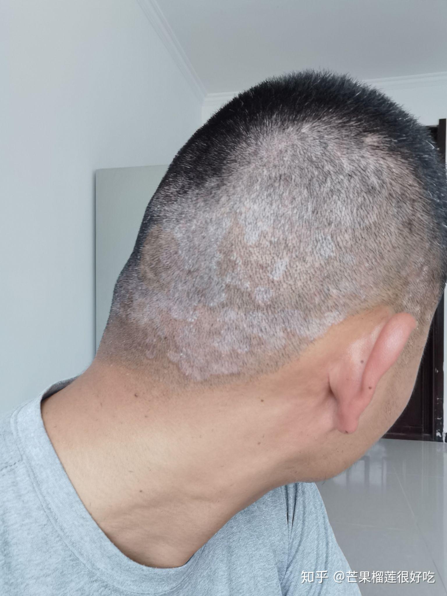见过的最大头皮屑多大? - 知乎