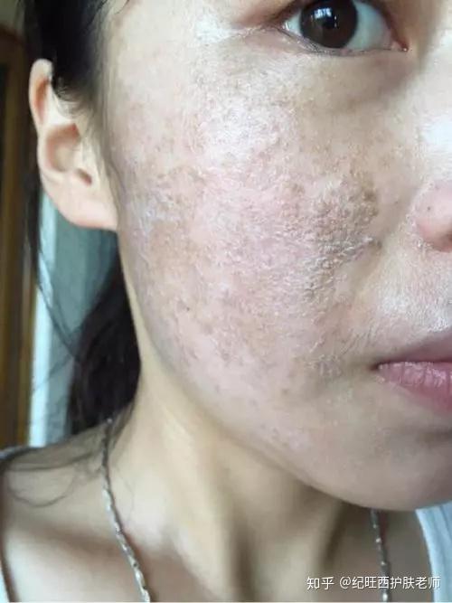 未治疗前的面部激素依赖性皮炎的结痂可以直接归类到重度激素依赖性