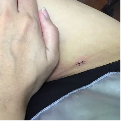 吸脂是典型的伤口小,创伤大的项目手术开的切口一般就2-8个(看你做的