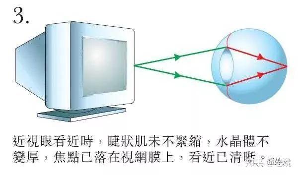 雾视疗法20年经验总结