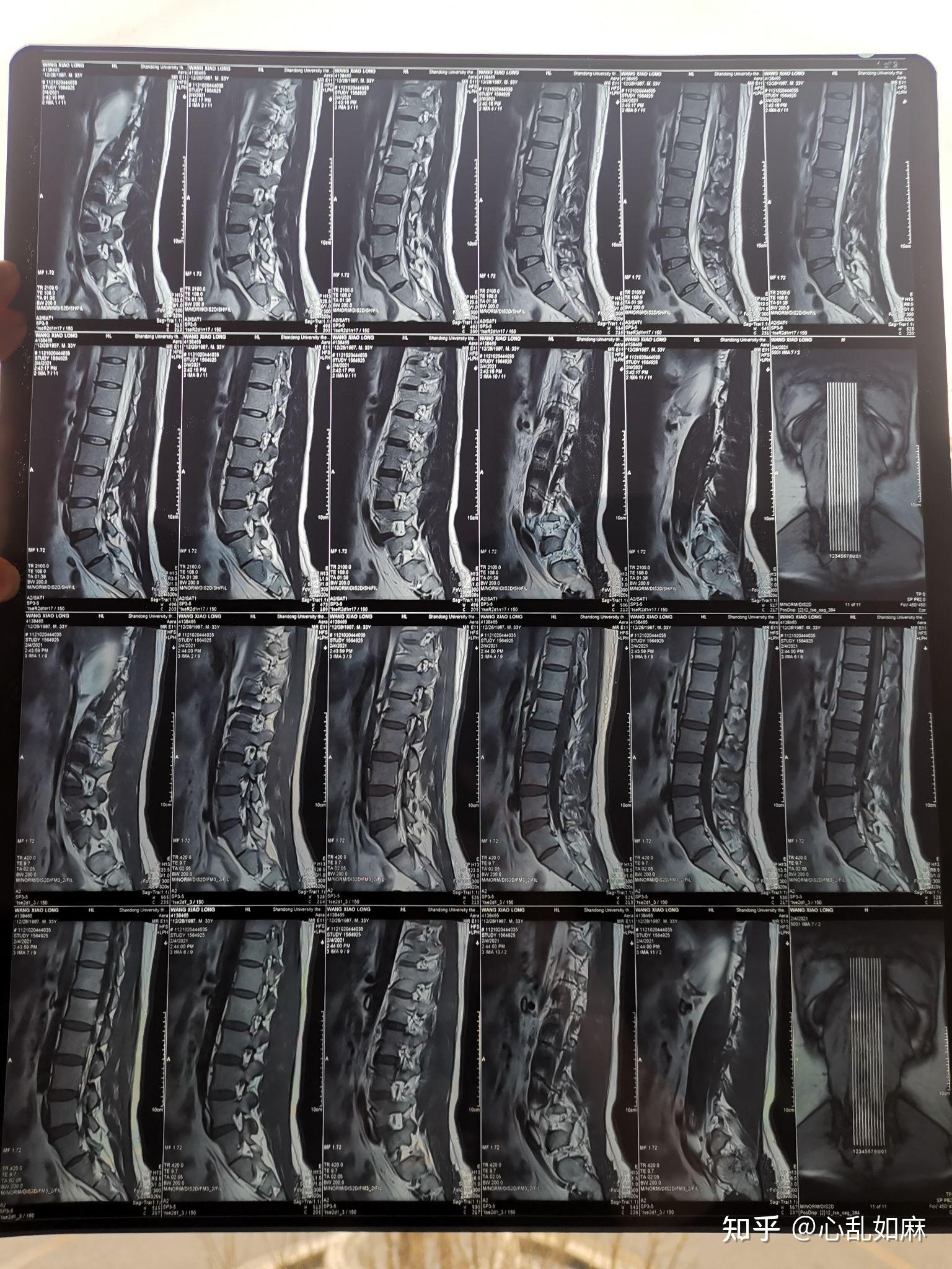 腰椎磁共振片子图片