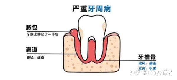 牙龈炎和牙周炎只有一字之差,区别竟然这么大! - 知乎