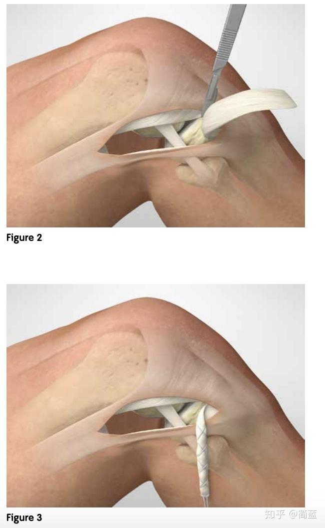 暴露髂胫带,做一个斜向的皮肤切口,从gerdys结节至外上髁.
