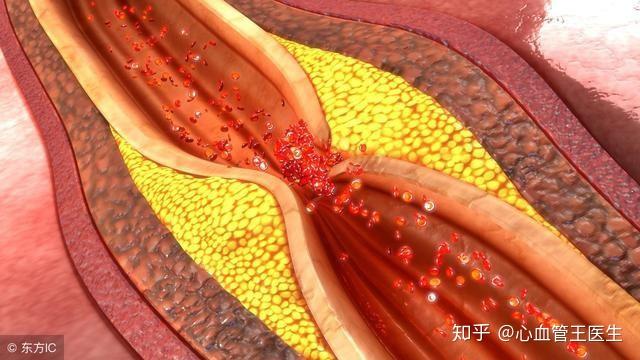 第一,动脉血栓的最常见原因,就是动脉粥样硬化,动脉粥样硬化加重,斑块