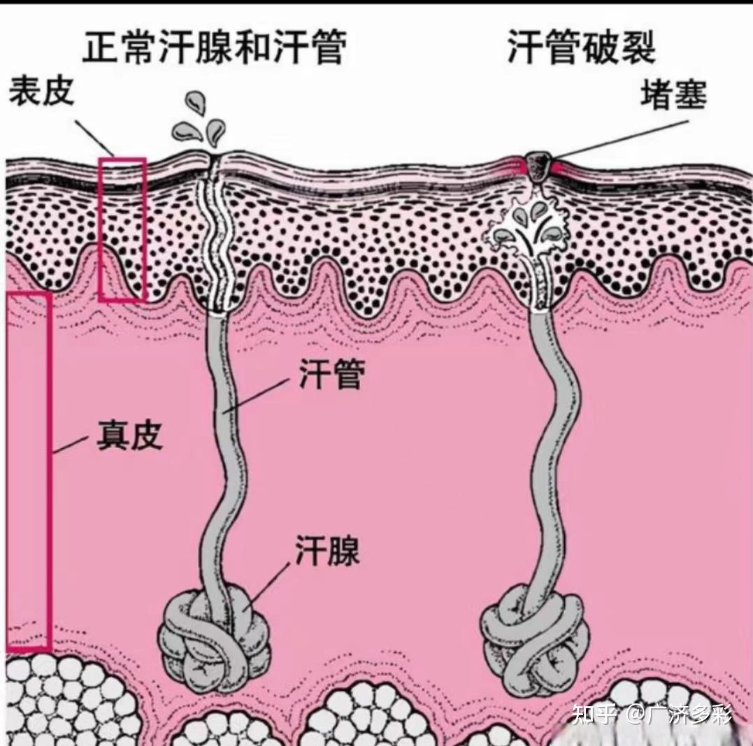 腋下、肛周皮肤反复长包流脓，警惕化脓性汗腺炎 - 知乎