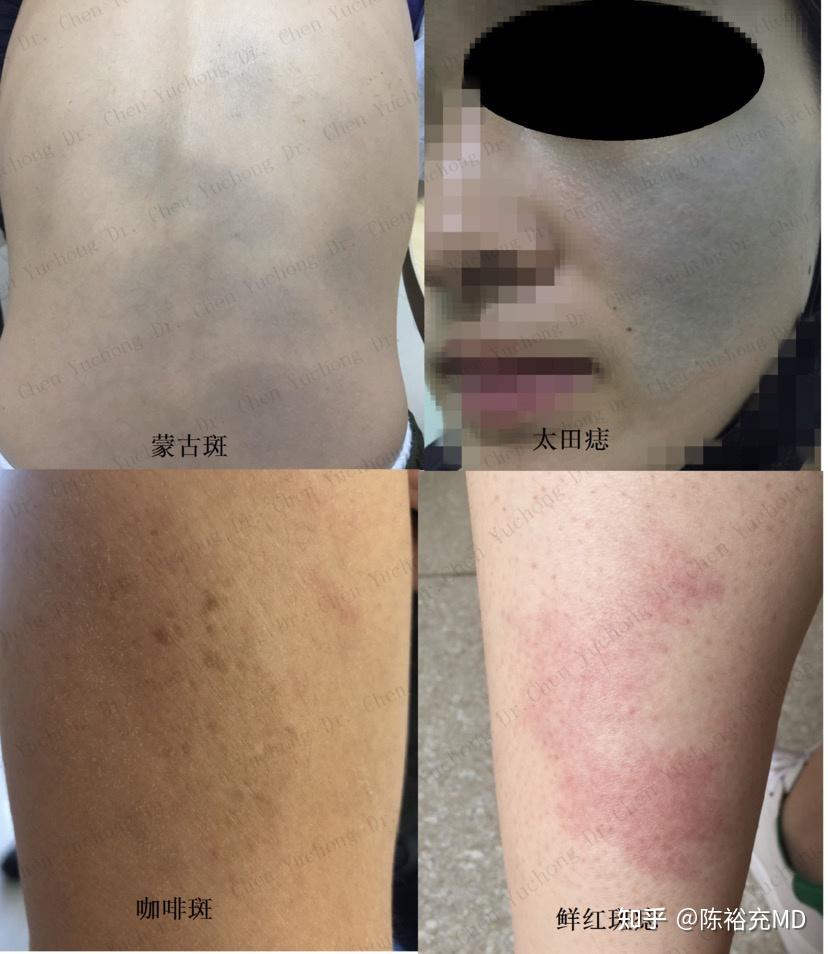 咖啡斑就更加常见了,许多人身上有咖啡色的小斑片,一般不会带来健康