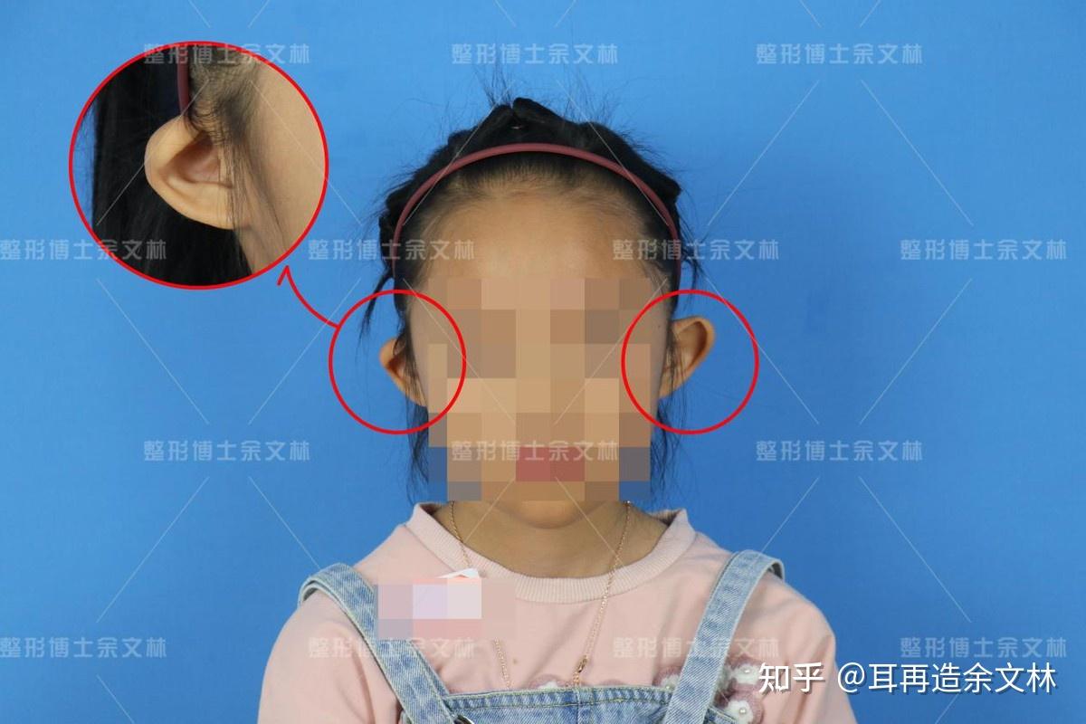 五六岁孩子的杯状耳能挼好吗?不治疗可不可以?