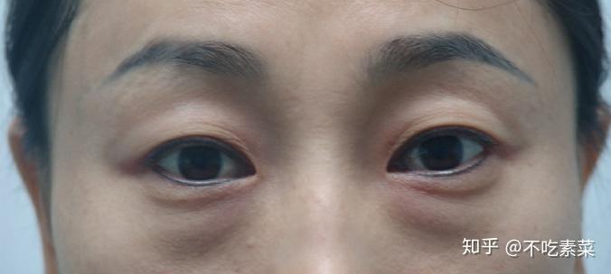 谁知道在重庆做去眼袋手术哪里好?求推荐?