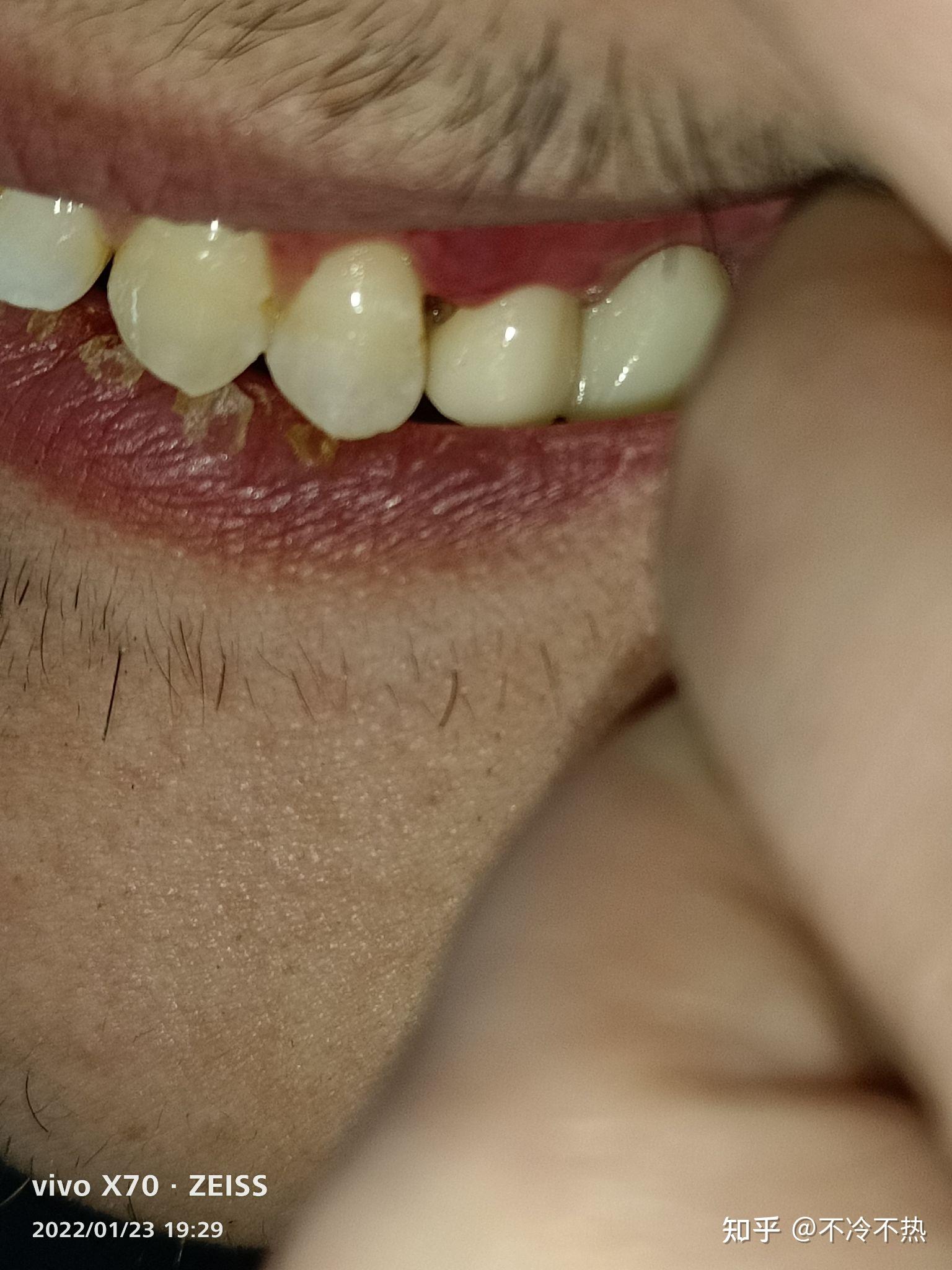 牙龈萎缩的症状表现 - 知乎