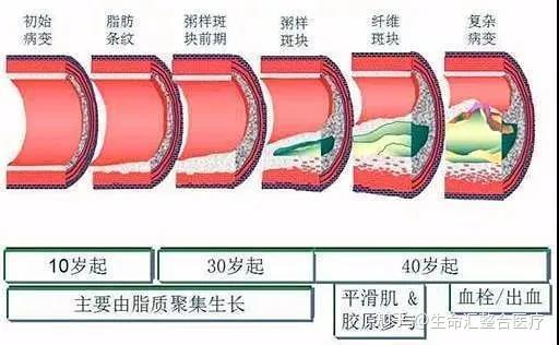 生命汇国际整合医疗|你的血管堵没堵,弯腰摸这里就知道! - 知乎