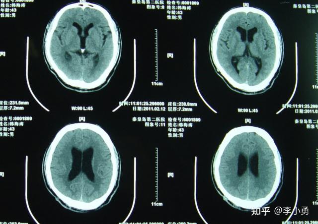 小腦扁桃體下疝脊髓空洞枕下減壓術後假性腦膜膨出腦積水手術治療失敗