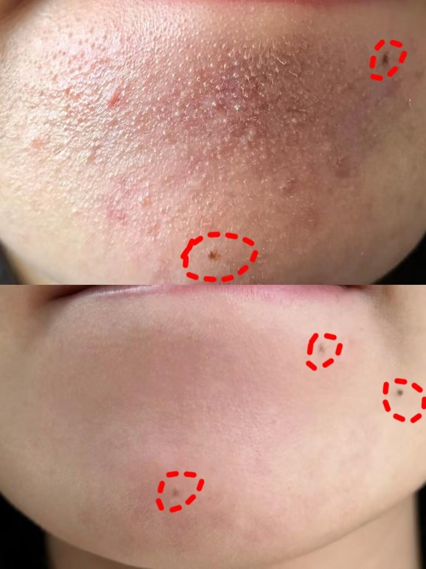 三:脸上痘痘,闭口去,去,去