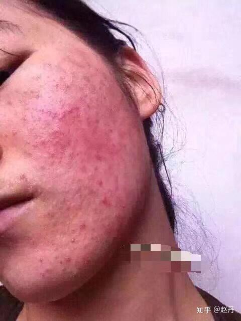 脸部出现潮红激素脸其实是面部激素依赖性皮炎,是由于长期大量外用糖