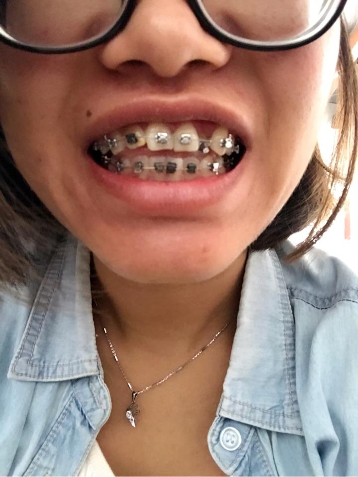 牙齿矫正是怎么样的感受,矫正过程中和矫正后