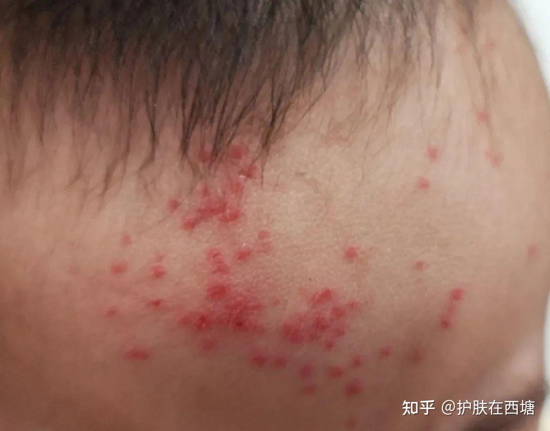 新冠阳性时的皮肤表现(一):大痘痘和病毒疹 - 知乎