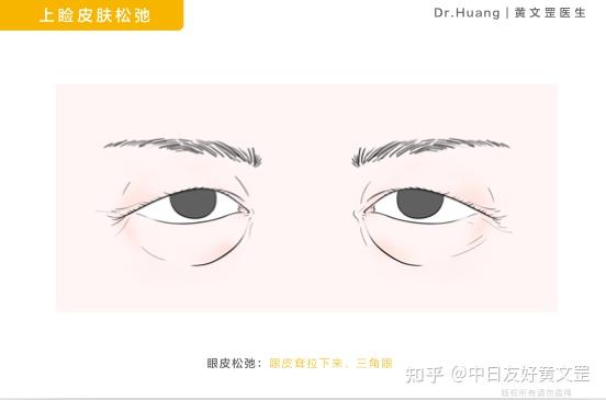 你的眼睛为什么看起来那么凶三角眼该怎么办