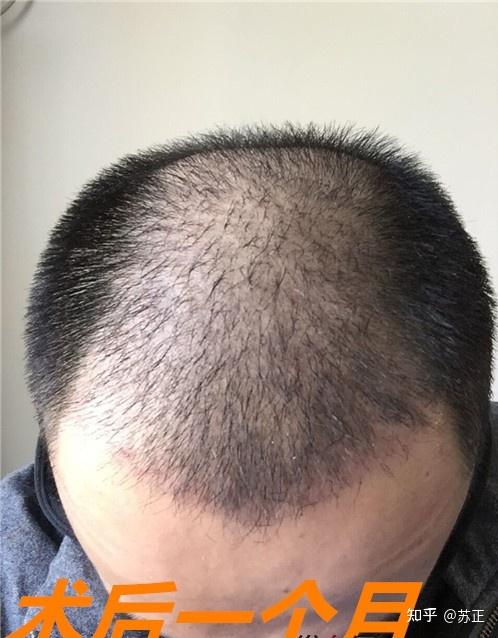 植发必看头顶加密植发3510单位两年后效果