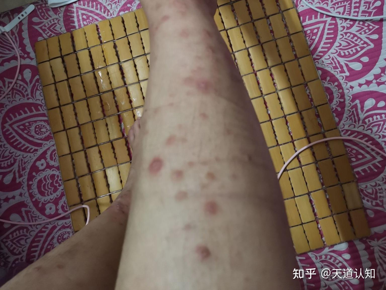 结节性痒疹的故事