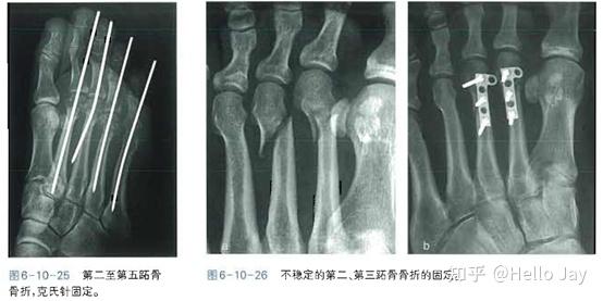 籽骨骨折,罕见,可自行愈合,若持续疼痛,可使用1-2个1.