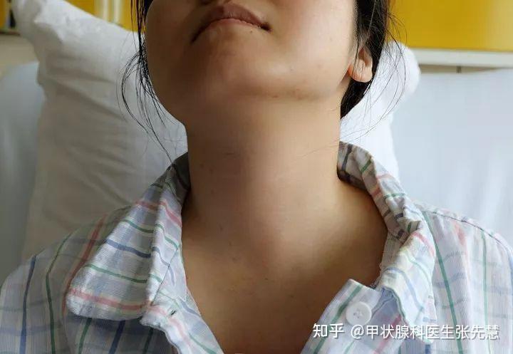 真实案例女大学生突发甲亢久治不好中医三月调理症状消失