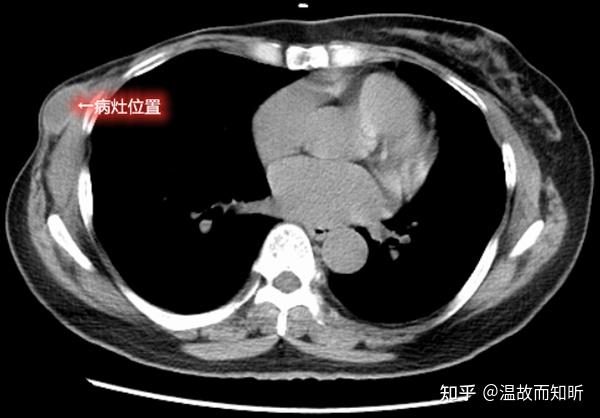 乳腺癌术后的胸壁结节都是恶性的吗
